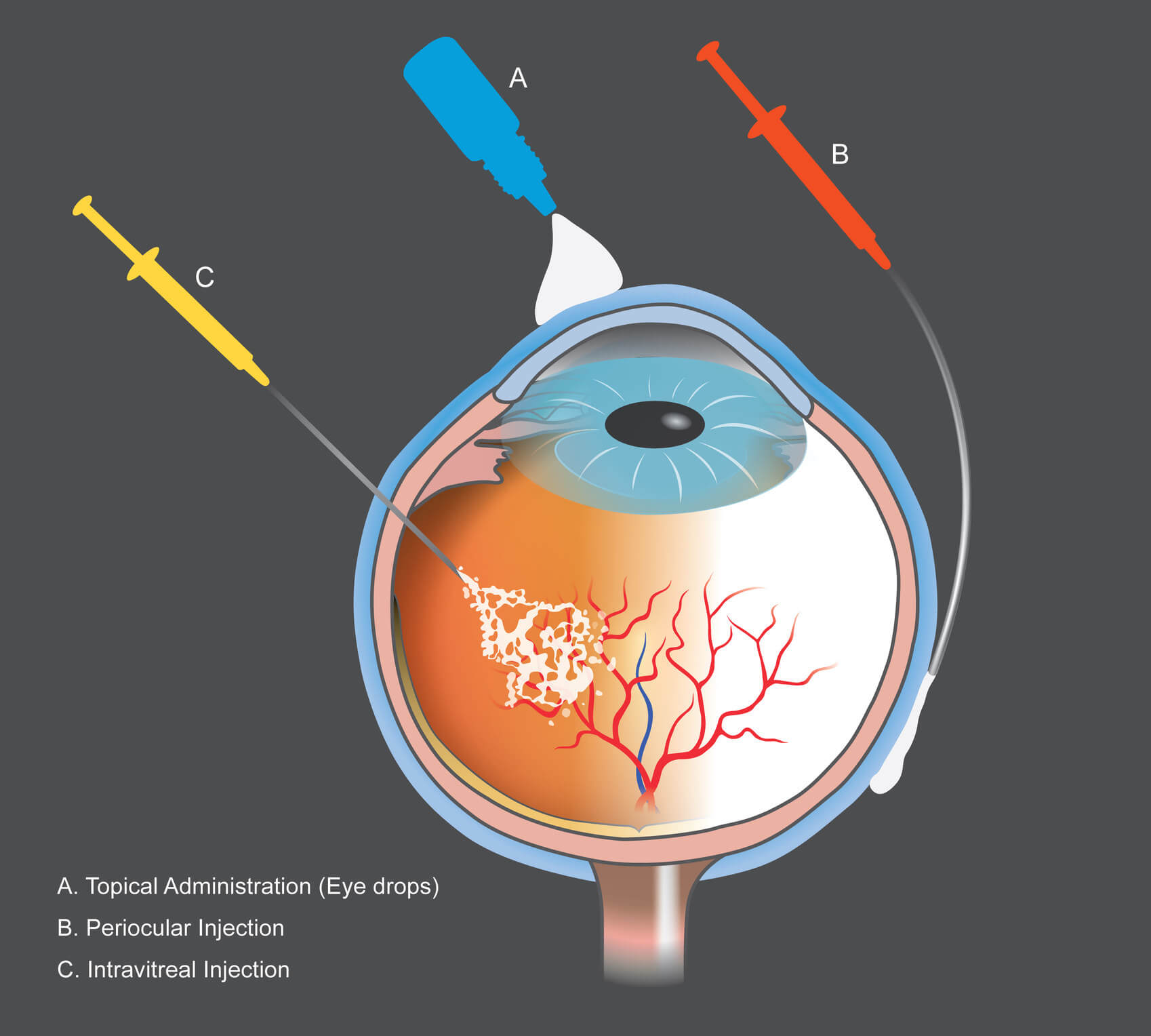 Intravitreal Injections at Lehigh Eye Specialists Lehigh Eye Specialists